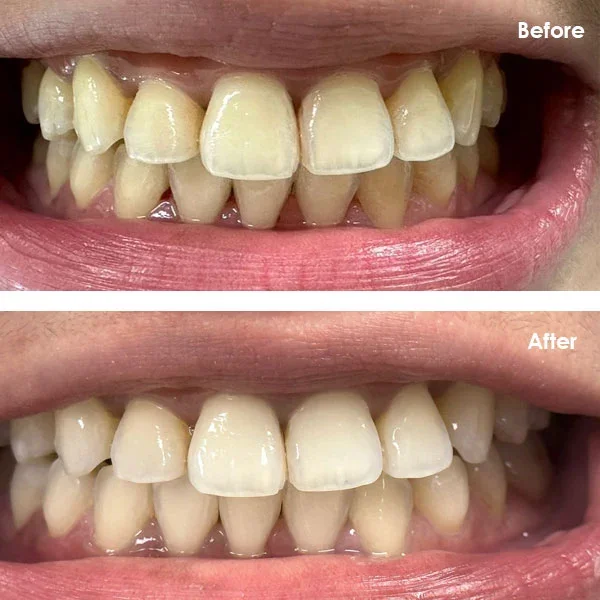 Smile gallery 5: original before-and-after dental photographs from Legacy Care