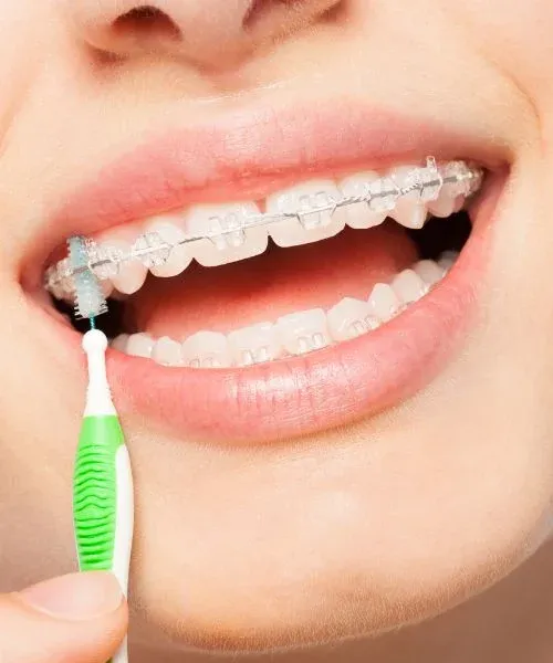 Ceramic Braces: editorial image from Legacy Care