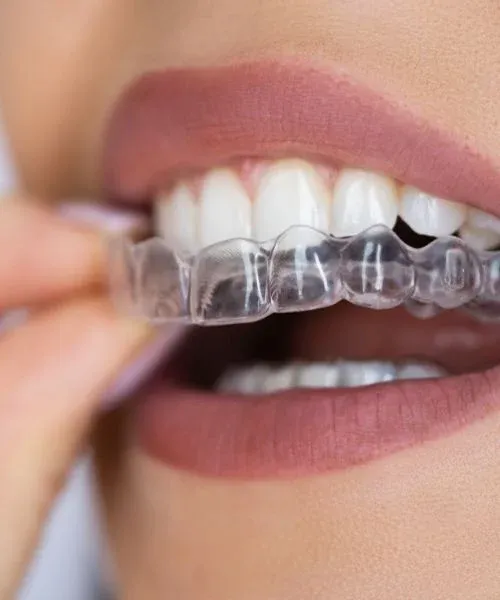 Clear Aligners: editorial image from Legacy Care