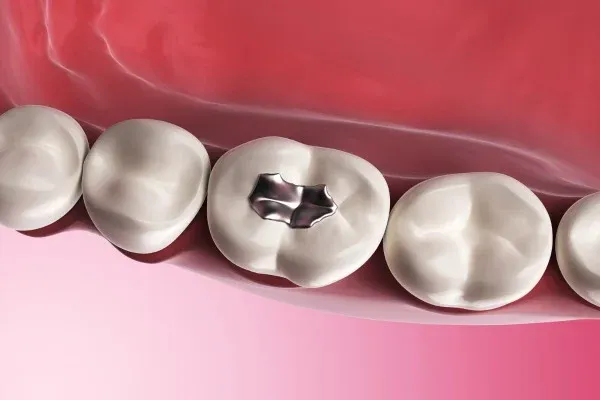 Dental Filling: editorial image from Legacy Care