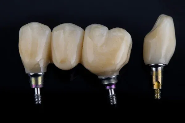 Dental Bridges: editorial image from Legacy Care