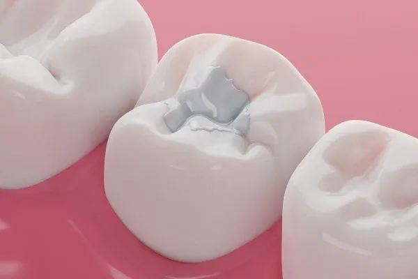 Composite Resin Fillings: editorial image from Legacy Care