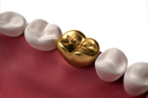 Gold Fillings: editorial image from Legacy Care