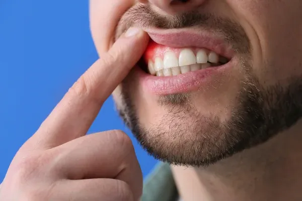 Gum Treatment: editorial image from Legacy Care