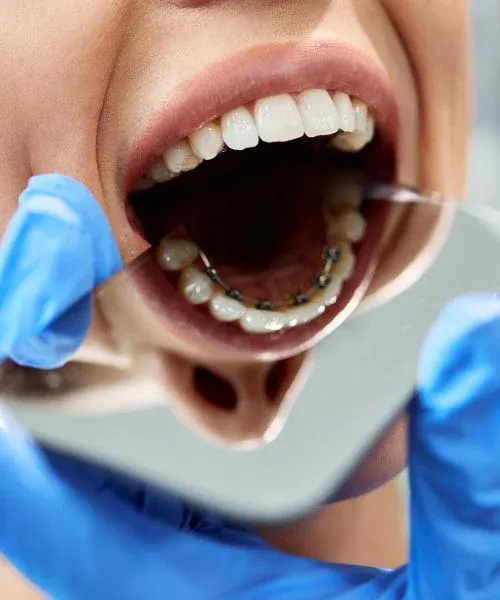 Lingual Braces: editorial image from Legacy Care
