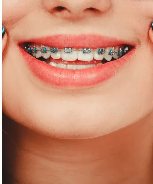 Metal Braces: editorial image from Legacy Care
