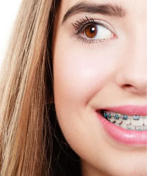 Damon Braces: editorial image from Legacy Care