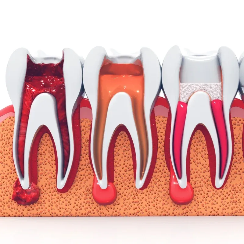 Re-Root Canal Treatment: editorial image from Legacy Care