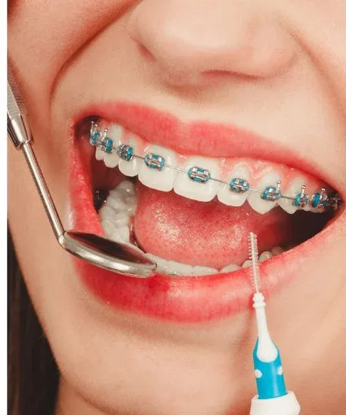 Dental Braces: editorial image from Legacy Care