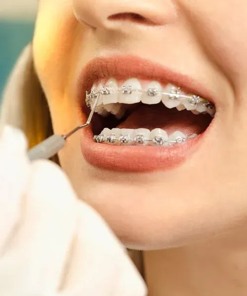Self-Ligating Braces: editorial image from Legacy Care