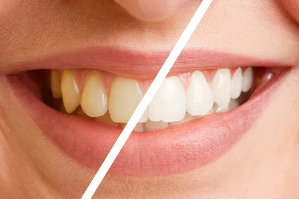Dental Cleanings and Exams: editorial image from Legacy Care