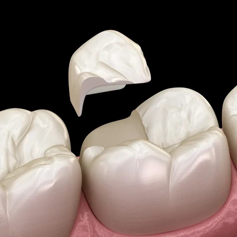 Dental Crowns: editorial image from Legacy Care