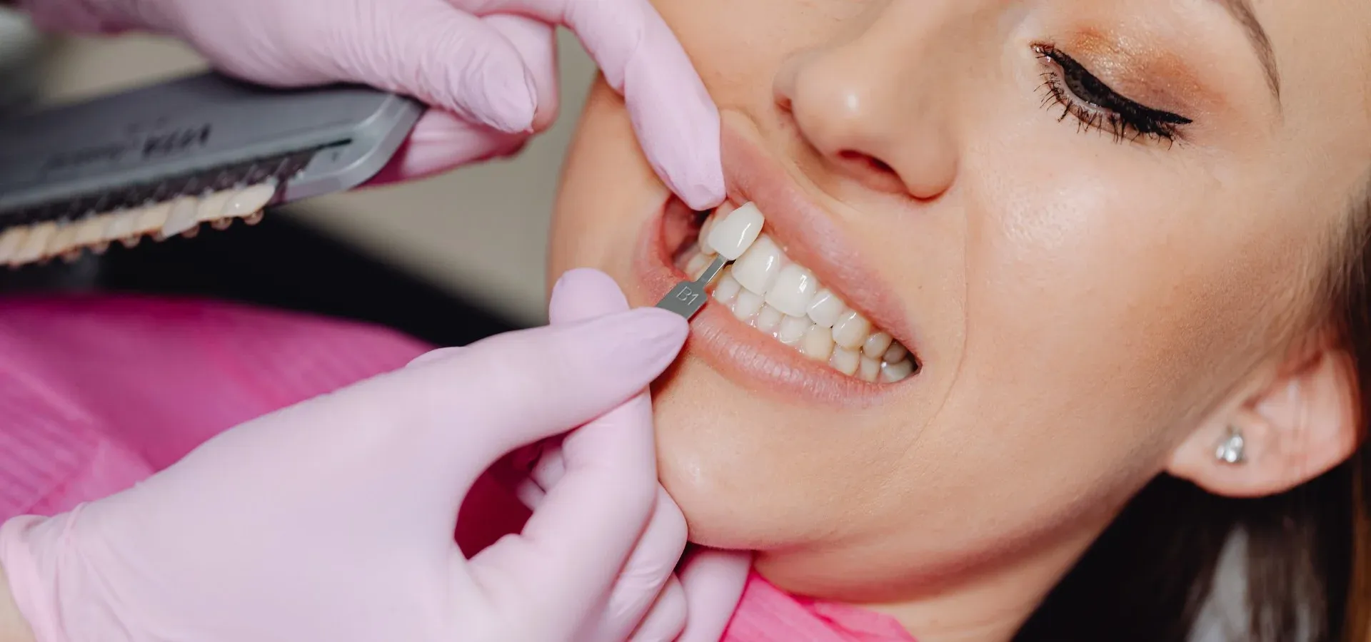 Composite Veneers: editorial image from Legacy Care